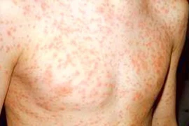 Các biến chứng nguy hiểm của bệnh sởi