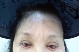 Mù mắt, biến dạng sau phẫu thuật cắt mí mắt