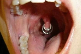 Kiểu xỏ khuyên miệng đau đớn nhất