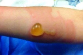 Sai lầm “chết người” khi chữa bỏng bô xe máy