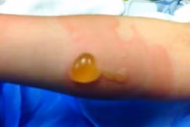 Sai lầm “chết người” khi chữa bỏng bô xe máy