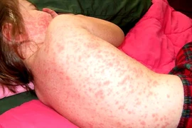 Dấu hiệu bé yêu bị sởi