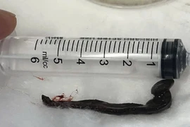 Phát hiện con vắt dài hơn 6 cm sống cả tuần trong mũi bệnh nhân