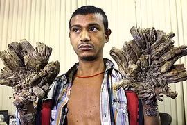 Khổ sở với căn bệnh tay, chân mọc tua tủa như rễ cây