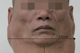  Kinh hãi chiếc cổ phình to như lạc đà vì 30 năm nhậu
