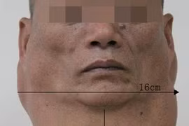  Kinh hãi chiếc cổ phình to như lạc đà vì 30 năm nhậu