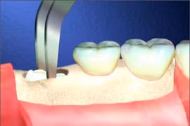 Rùng mình xem quy trình nhổ răng khôn hiểm hóc