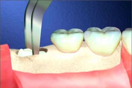 Rùng mình xem quy trình nhổ răng khôn hiểm hóc