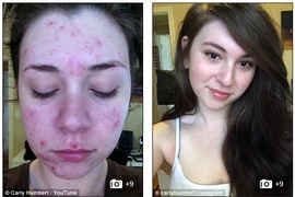 Gái trẻ bị mụn chi chít vì đặt vòng tránh thai