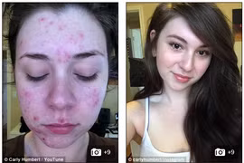 Gái trẻ bị mụn chi chít vì đặt vòng tránh thai