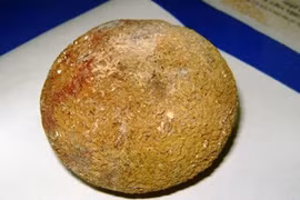 Sỏi thận “khủng” trú trong cơ thể 10 năm