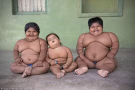 Bi đát cha phải bán thận điều trị béo phì cho con