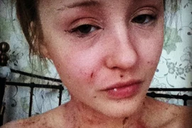 Thiếu nữ chàm eczema "lột xác" nhờ cháo yến mạch