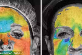 Ảnh 3D gây sửng sốt về tác động của botox lên da mặt