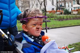 Bé 7 tuổi can đảm chịu 50 lần phẫu thuật não