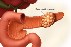 Những dấu hiệu dễ bị bỏ qua của ung thư tuyến tụy