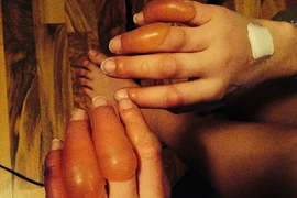 Suýt mất bàn tay vì bỏng lạnh kinh hoàng