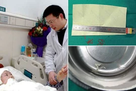 Phát hiện sán dài 10cm “làm tổ” trong não thiếu nữ