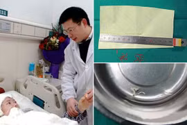 Phát hiện sán dài 10cm “làm tổ” trong não thiếu nữ