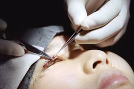 Những hình ảnh phẫu thuật cắt mí đầy đau đớn