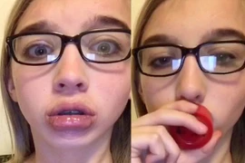 Trào lưu hít chai để môi sưng vù như Kylie Jender