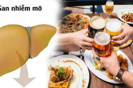 Bệnh gan nhiễm mỡ có phải do rượu bia, ăn nhậu?