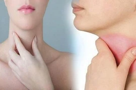 Nếu thấy 3 tín hiệu này ở cổ, cần đi khám K tuyến giáp ngay