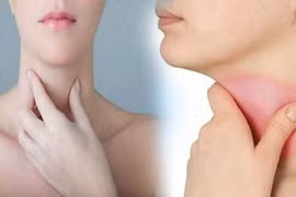 Nếu thấy 3 tín hiệu này ở cổ, cần đi khám K tuyến giáp ngay
