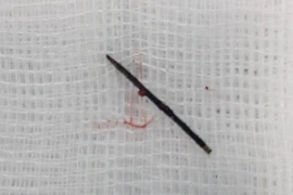 Kim khâu gỉ đen trong cơ thể bé gái 3 tuổi