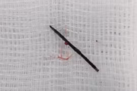 Kim khâu gỉ đen trong cơ thể bé gái 3 tuổi