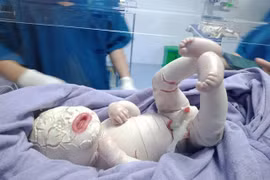 Thương tâm bé sơ sinh mắc bệnh hiếm da toàn thân dày, nứt từng mảng