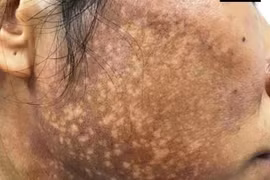 Bôi kem trộn làm trắng da, người phụ nữ nhận cái kết khủng khiếp