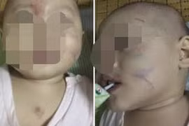 Lộ nguyên nhân bé gái 14 tháng tuổi ở Hải Phòng bầm mặt trong ngày đầu đến lớp