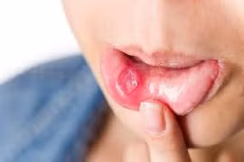 Những lưu ý cơ bản phòng ngừa ung thư khoang miệng