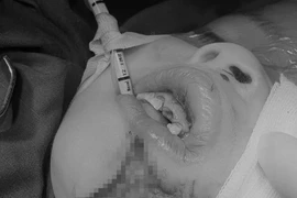 Bé trai 4 tuổi bị chó cắn rách cằm