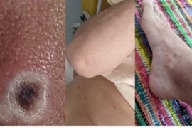 Ca đầu tiên mắc đậu mùa khỉ: ‘Tôi phát hiện bệnh khi đi khám vùng kín’