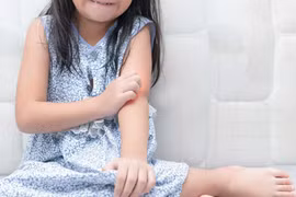 Những bệnh ngoài da thường gặp ở trẻ