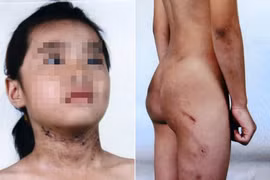 Bé 6 tuổi bị mẹ kế bạo hành như thời trung cổ