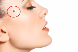 5 vị trí nốt ruồi xui xẻo, hủy hoại vận mệnh của một người