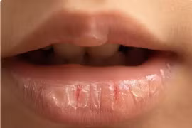 Những thực phẩm có sẵn trong bếp giúp chữa lành đôi môi nứt nẻ