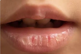 Những thực phẩm có sẵn trong bếp giúp chữa lành đôi môi nứt nẻ