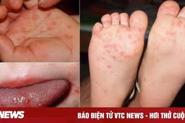 Cha mẹ cảnh giác: Ba triệu chứng báo hiệu bệnh tay chân miệng trở nặng