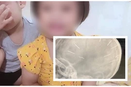 Có 10 chiếc đinh trong hộp sọ bé gái bị bạo hành ở Hà Nội