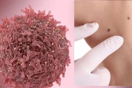 Nốt ruồi mọc ở 3 bộ phận hay “liên quan mật thiết” đến ung thư