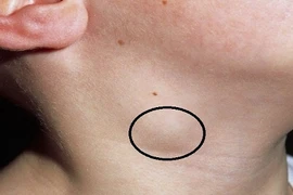 Có những dấu hiệu này, mau đến bệnh viện kiểm tra kẻo ung thư hạch