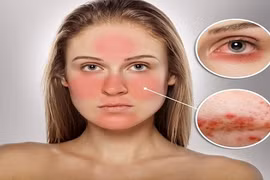 Cách đơn giản chăm sóc da nhạy "đỏng đảnh"