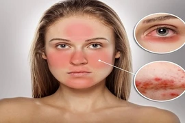 Cách đơn giản chăm sóc da nhạy "đỏng đảnh"