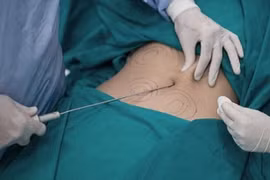 Thanh tra Sở Y tế TP HCM thông tin về trường hợp cấp cứu sau khi hút mỡ