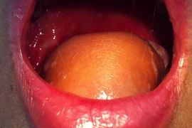 Cận cảnh ca tái tạo lưỡi cho bệnh nhân ung thư