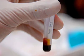 Cách đơn giản giúp chẩn đoán ung thư đầu cổ